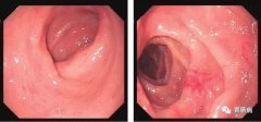 萎縮性胃炎不可怕，只要