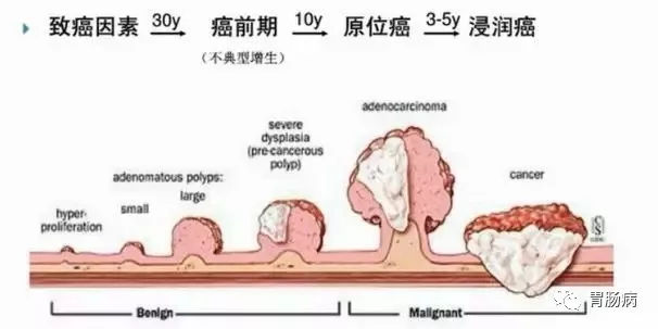 體檢查出腸息肉一定要切除！ 95%腸癌由它演變而來