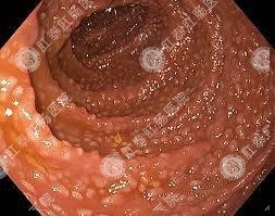 南寧直腸息肉手術多少錢