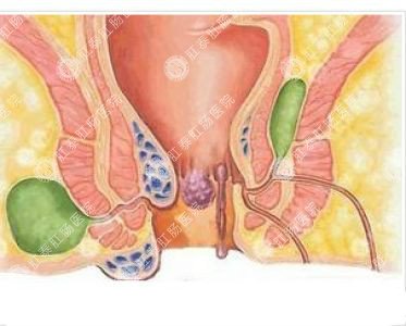 南寧哪個醫(yī)院可以做肛周膿腫？